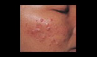 articlesThumb_23_1_acne (big).jpg